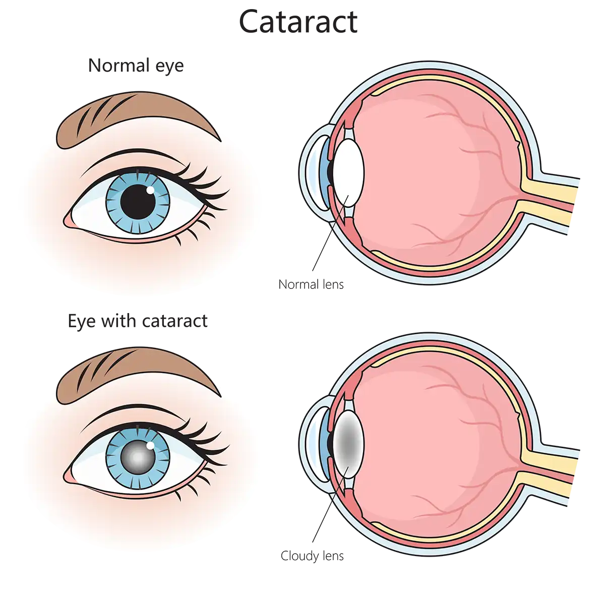 graphic depicting normal eye and eye with cataract